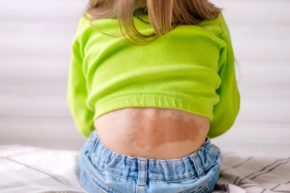 vascular malformation