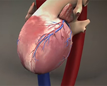 Transfemoral procedure