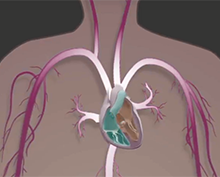 Aortic Stenosis